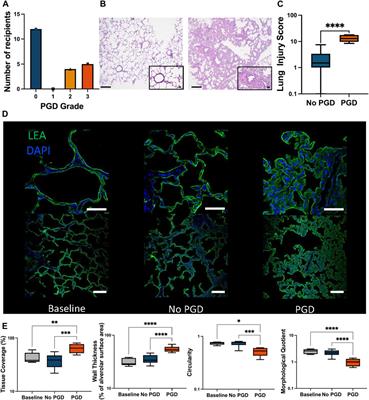 Proteomic Analysis of Primary Graft Dysfunction in Porcine Lung Transplantation Reveals Alveolar-Capillary Barrier Changes Underlying the High Particle Flow Rate in Exhaled Breath